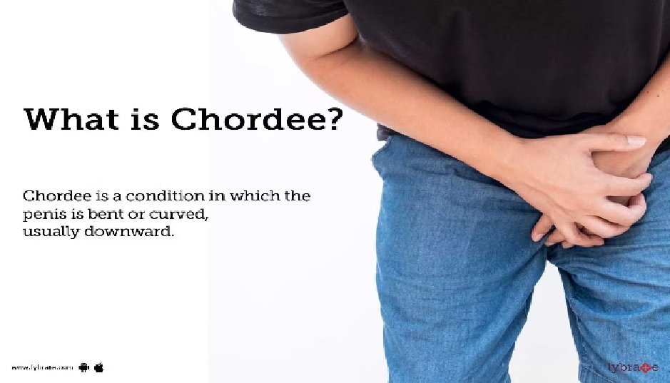 Understanding Chordee Repair: A Comprehensive Guide to Treatment and Recovery